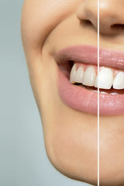 The Impact of Coffee, Tea, and Wine on Teeth Whitening Results