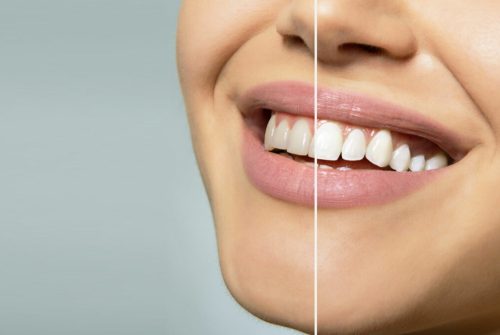 The Impact of Coffee, Tea, and Wine on Teeth Whitening Results
