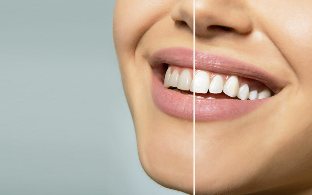 The Impact of Coffee, Tea, and Wine on Teeth Whitening Results